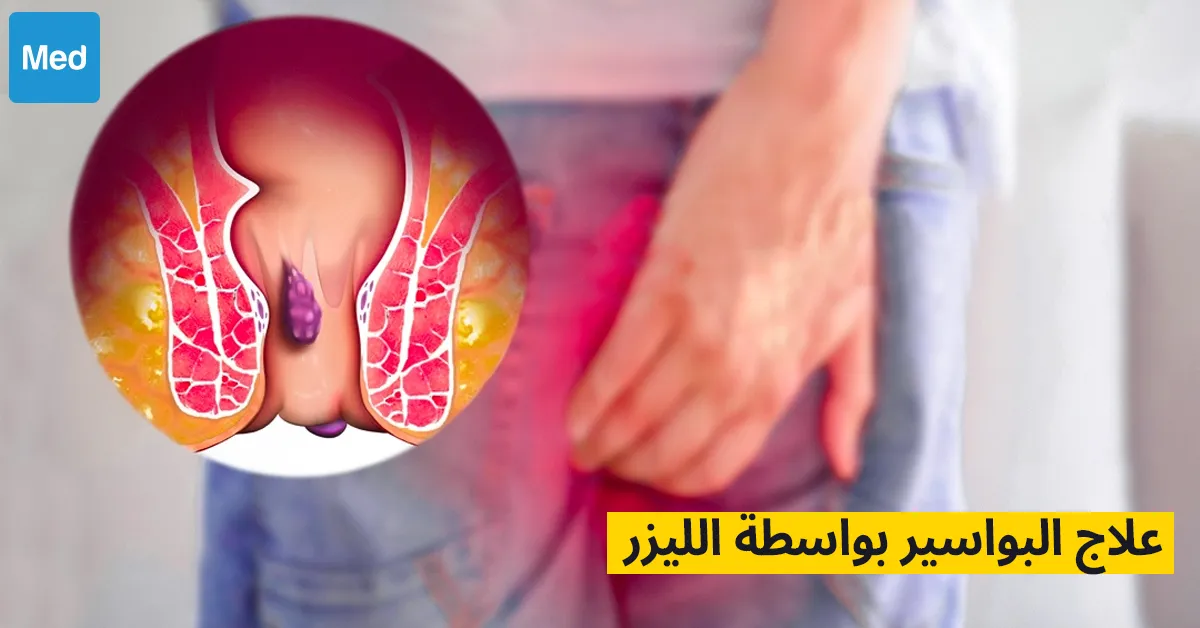 علاج البواسير بواسطة الليزر